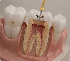 Endodontia e Tratamento de Canal